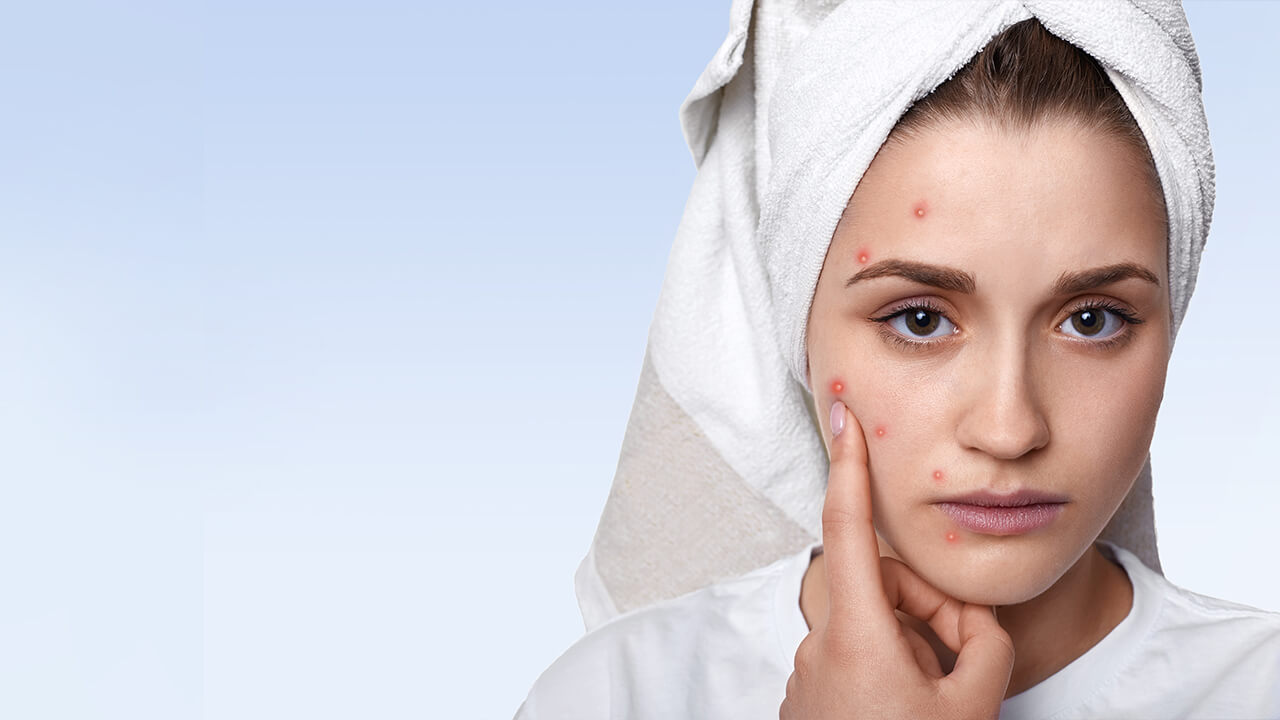 Tips To Remove Pimples on Face