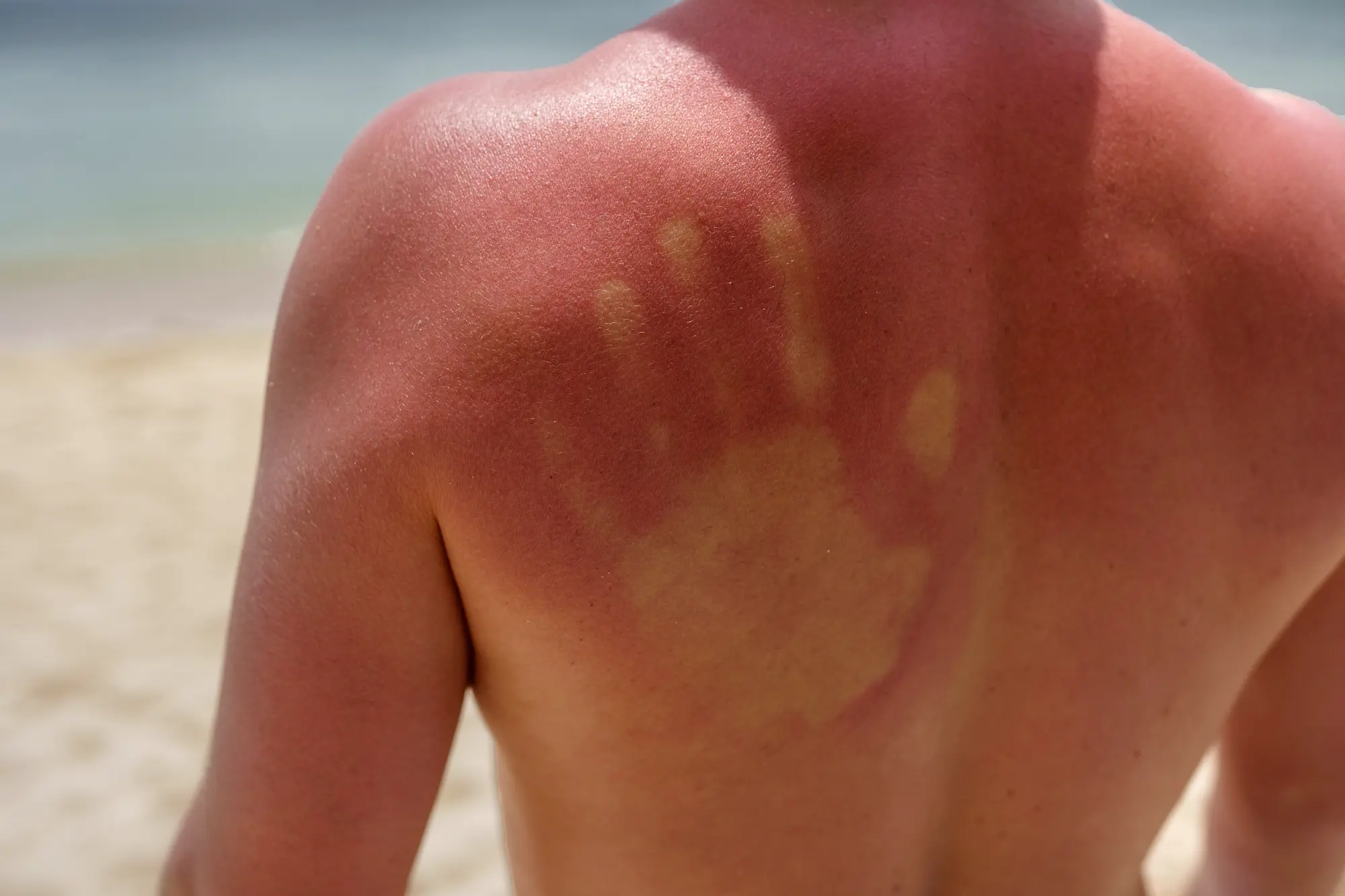 Heal sunburn with natural products
