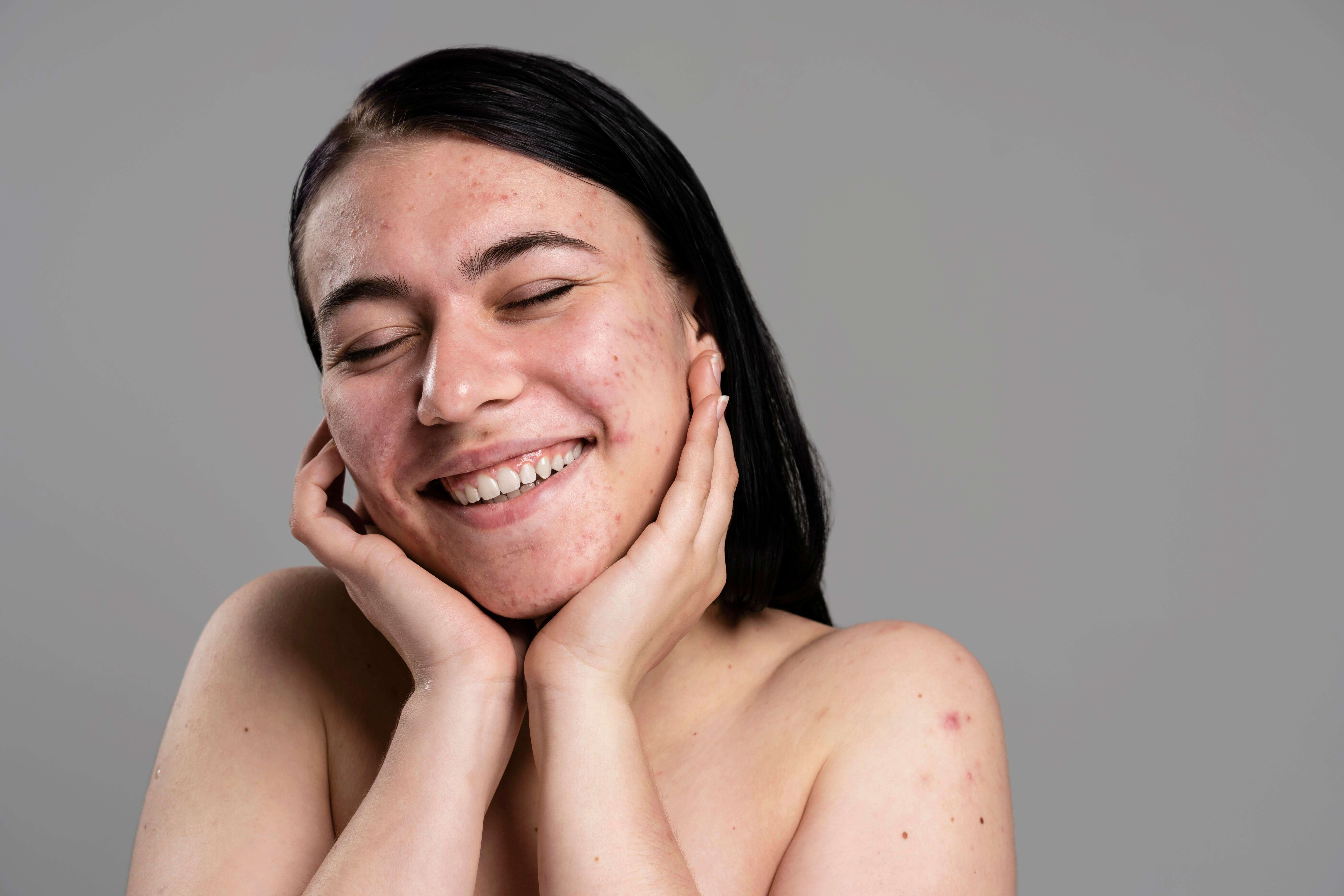 Best Skincare Routine for Acne Prone Skin